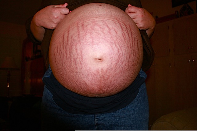 علامات تمدد الجلد أثناء الحمل