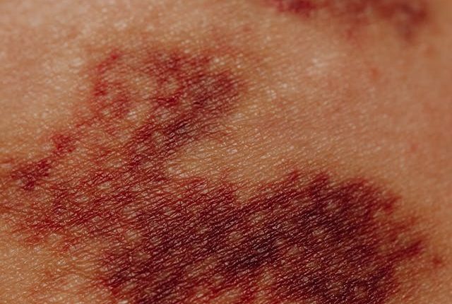 كدمات الجسم بدون سبب