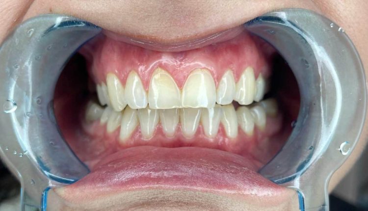 علاج تراجع اللثة