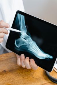علاج الشوكة العظمية